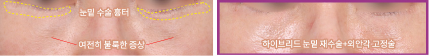 눈밑 수술 흉터, 여전히 불룩한 증상(좌) / 하이브리드 눈밑 재수술+외안각 고정술(우)