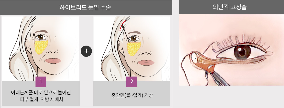 하이브리드 눈밑 수술 : 1.아래눈꺼풀 바로 밑으로 늘어진 피부 절제, 지방 재배치 + 2.중안면(볼~입가) 거상(좌) / 외안각 고정술(우)