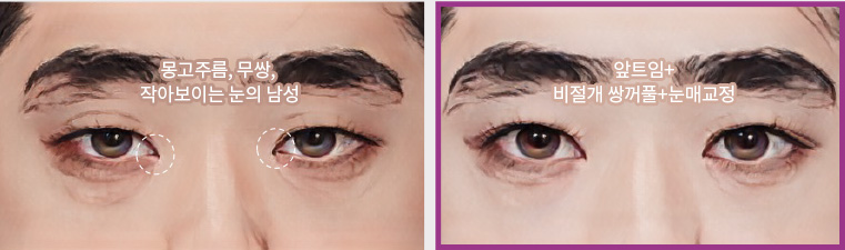 몽고주름, 무쌍, 작아보이는 눈의 남성(좌) / 앞트임+비절개 쌍꺼풀+눈매교정(우)