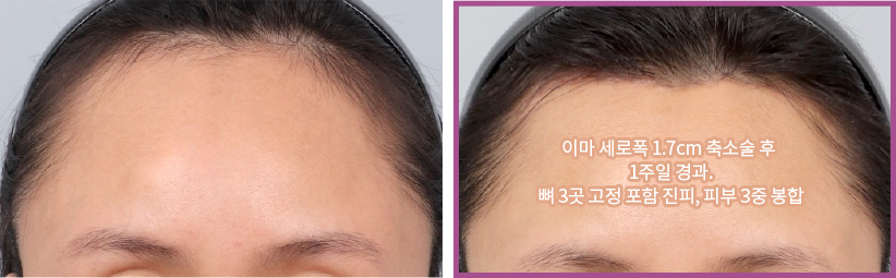 이마 세로폭 1.7cm 축소술 후 1주일 경과. 뼈 3곳 고정 포함 진피, 피부 3중 봉합(우)