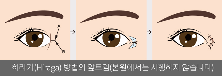 히라가(Hiraga) 방법의 앞트임(본원에서는 시행하지 않습니다.)