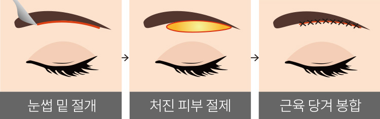 눈썹 밑 절개 > 처진 피부 절제 > 근육 당겨 봉합