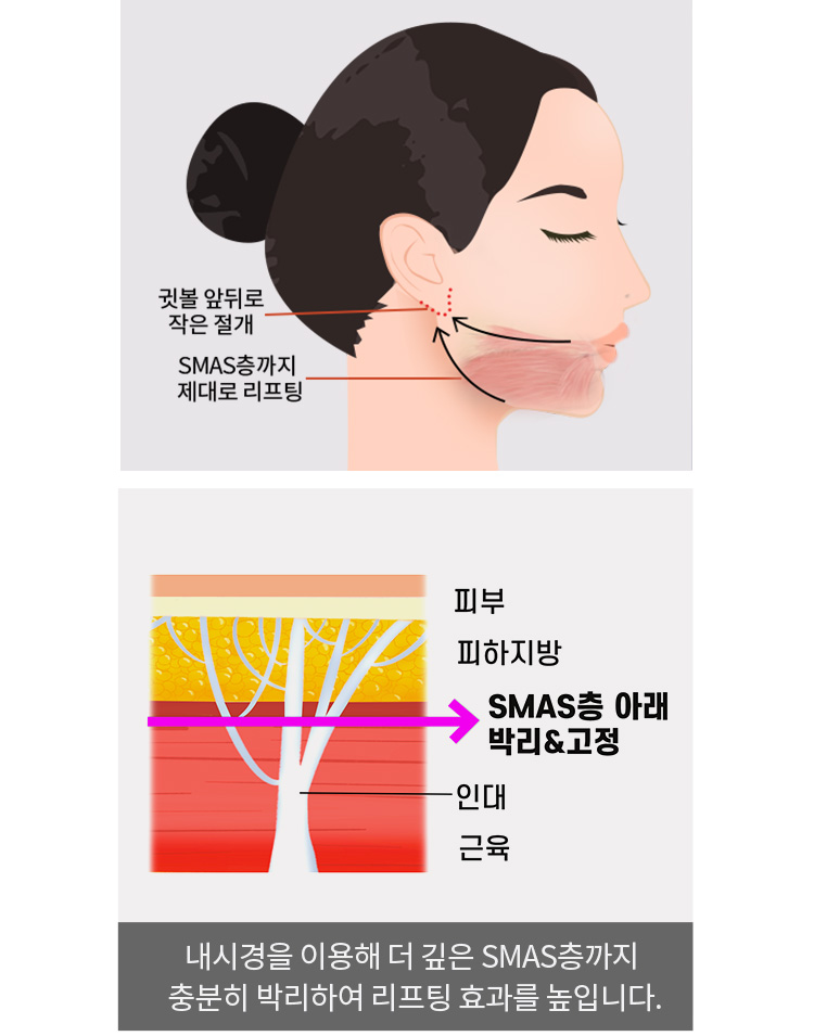 더 깊은 SMAS층까지 충분히 박리하여 리프팅 효과를 높입니다.